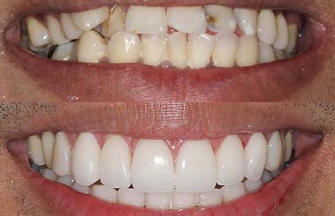 dentiste Courbevoie Levallois Blanchiments et facettes dentaires 
